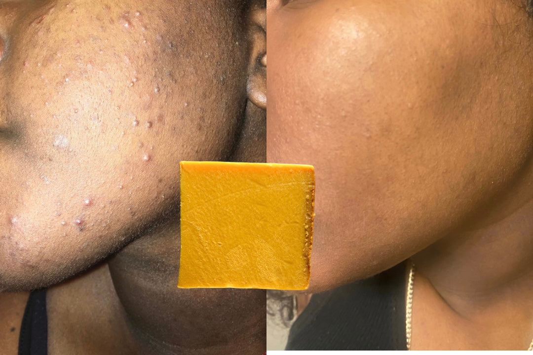 Skin Corrector Turmeric Soap